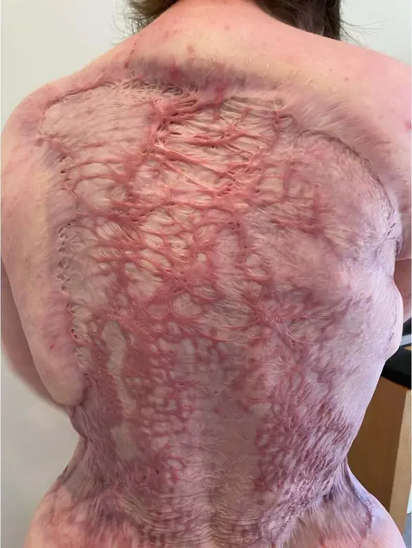 Juliane com queimaduras